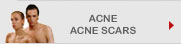 Acne - Acne Scars