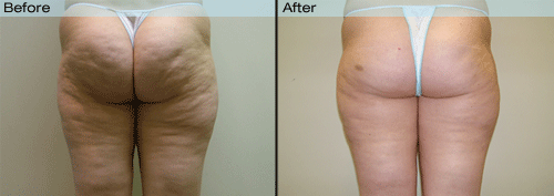 Velashape before and after pictures