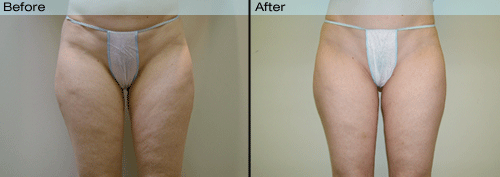 Velashape before and after pictures