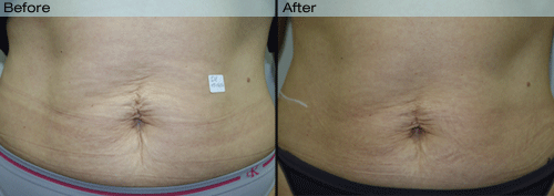 Velashape before and after pictures