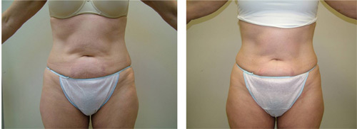 Velashape before and after pictures