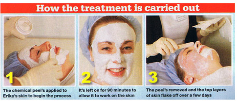 How the treatment is carried out