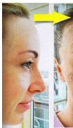 Melasma before and after pictures