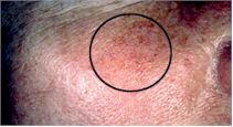 Rosacea before and after pictures