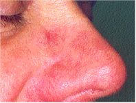 Rosacea before and after pictures