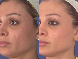 Pixel skin resurfacinf for Acne